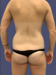 Liposuction 6 - Posterior Flanks Before